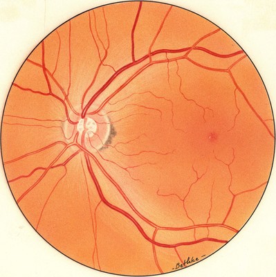 Retinal Diseases