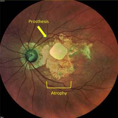 Transplants & Protheses 